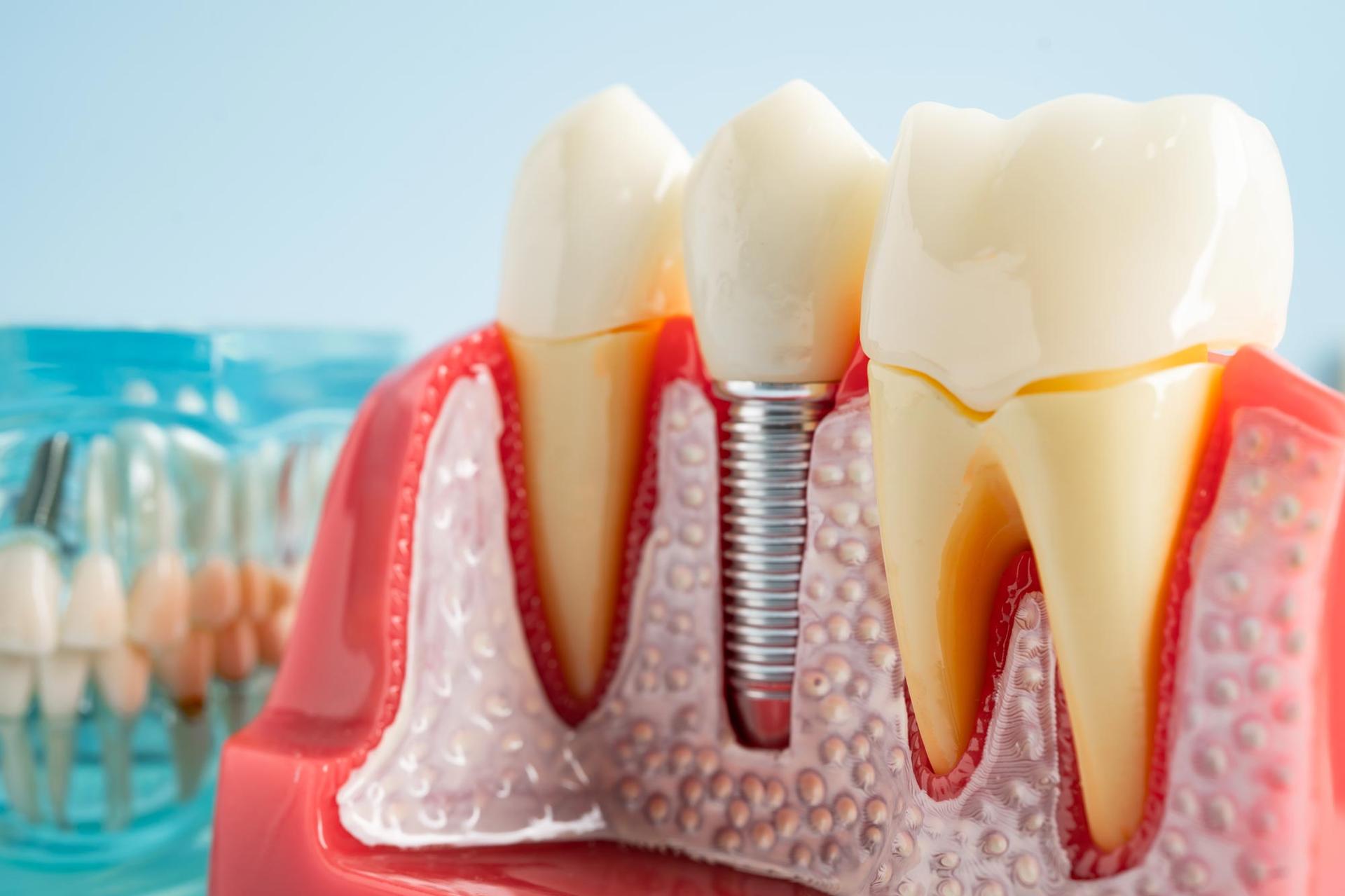 Researchers Solve the Mystery Behind a Billion-Dollar Dental Implant Disease