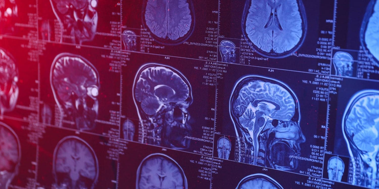 Reduced gray matter and altered brain connectivity are linked to problematic smartphone use